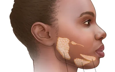 Understanding Dry Mouth: Common Symptoms and Effective Remedies